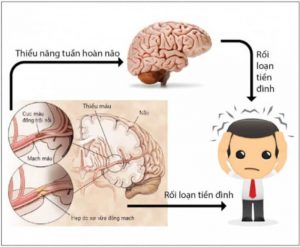 Có rất nhiều nguyên nhân gây thiếu máu rối loạn tiền đình