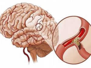 Nguyên nhân gây thiếu máu não mãn tính